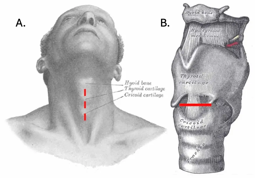 Ilustração anatômica da técnica de incisão em duas etapas para uma cricotireoidostomia cirúrgica aberta.