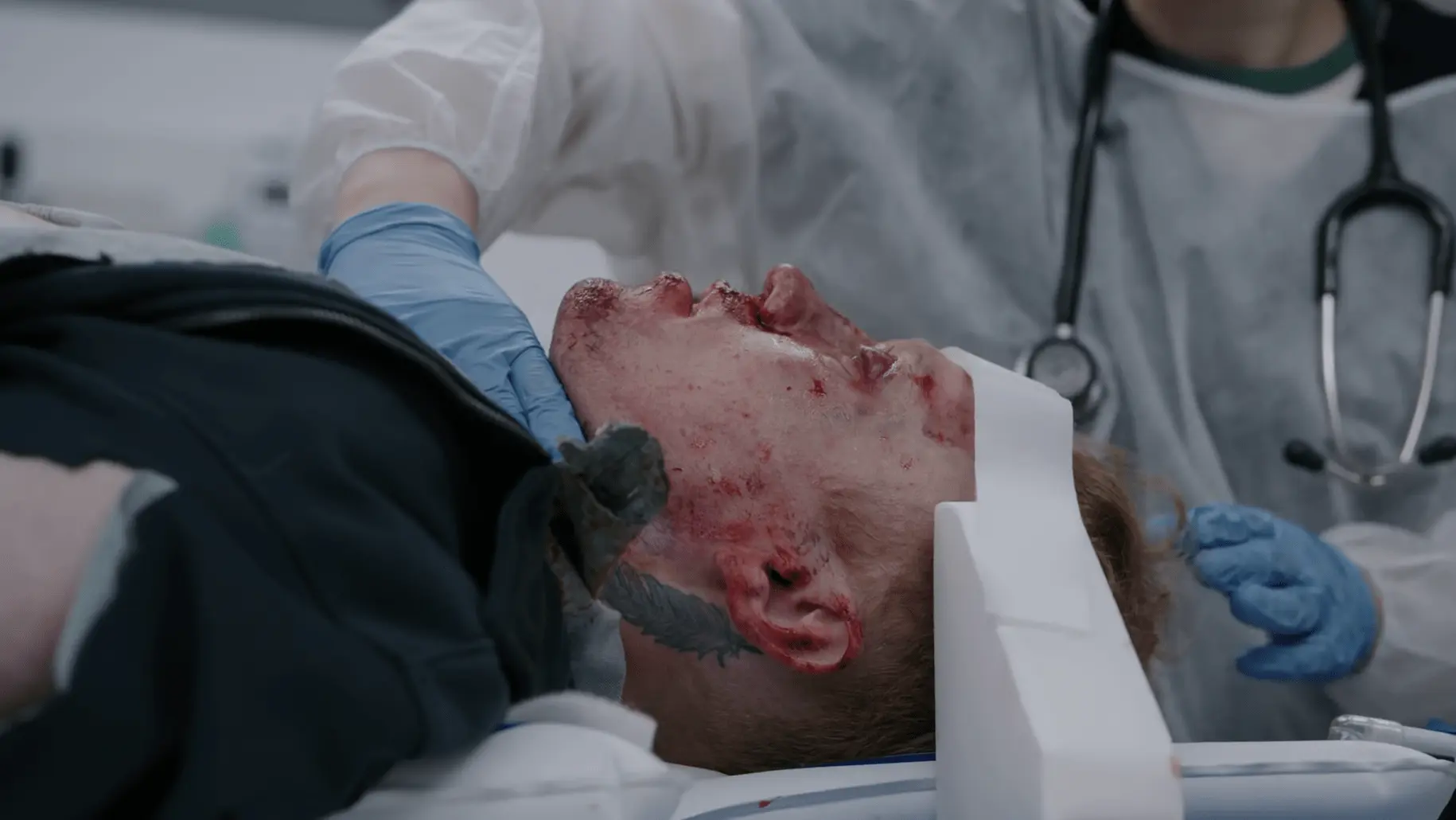 Patient stellt sich mit massivem Gesichtstrauma und Epistaxis nach E-Scooter-Kollision vor.