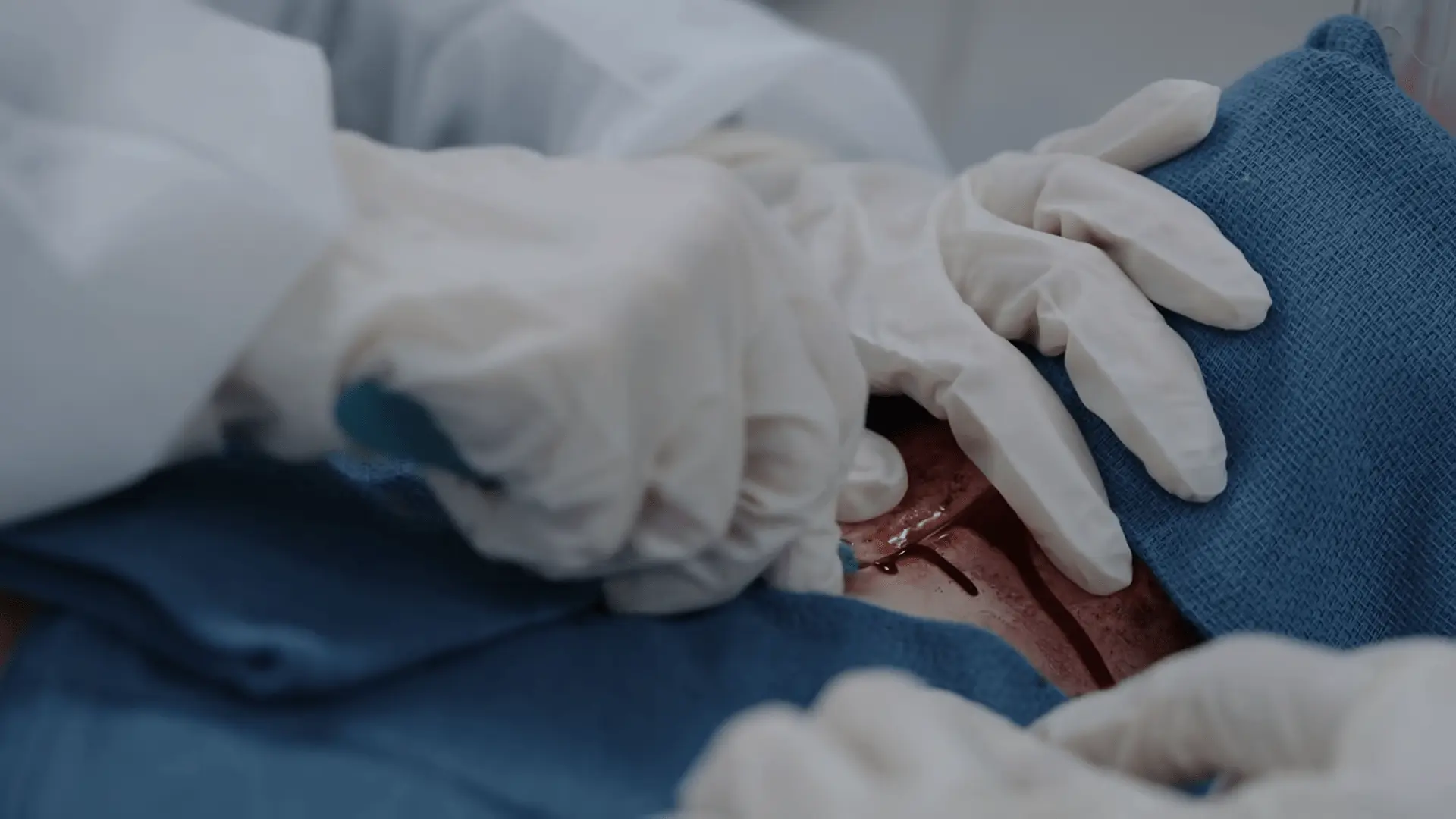 Cricotireoidostomia cirúrgica aberta utilizando uma incisão vertical na pele.