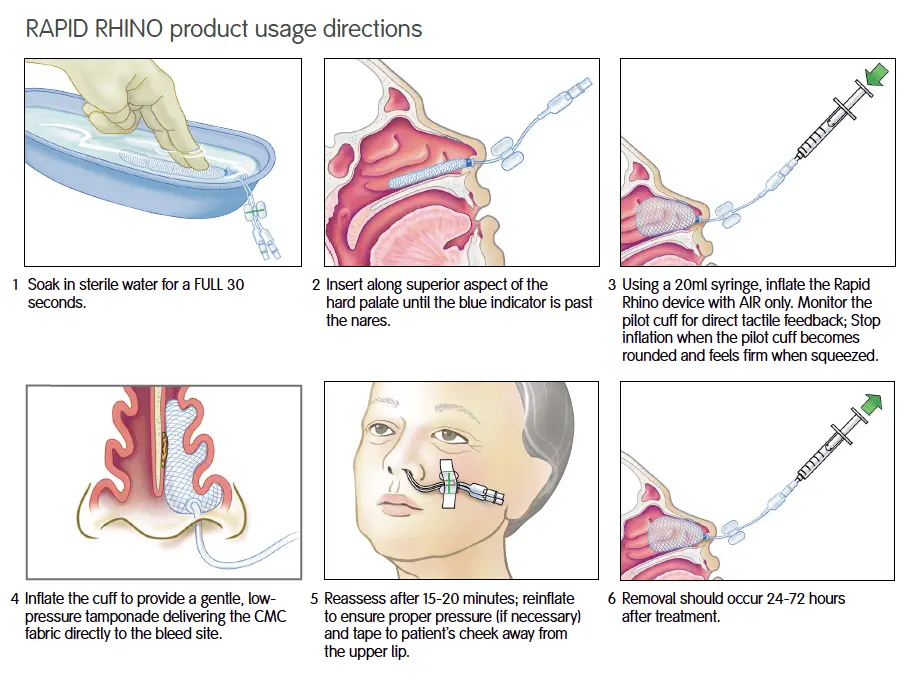 Instruções de uso do produto Rapid Rhino demonstrando a hidratação do dispositivo, inserção ao longo da face superior do palato duro e insuflação com ar utilizando uma seringa de 20ml.