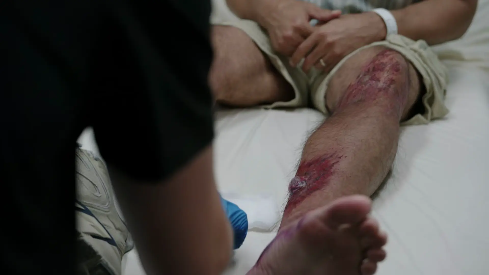 Ferida tibial lateral com hematoma central proeminente