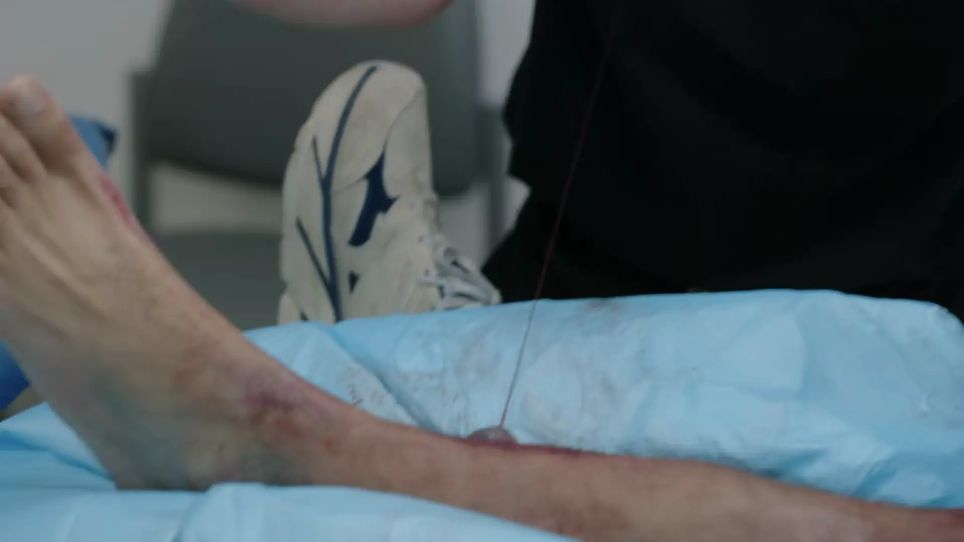 Hemorragia arterial pulsátil após o desbridamento da bolha
