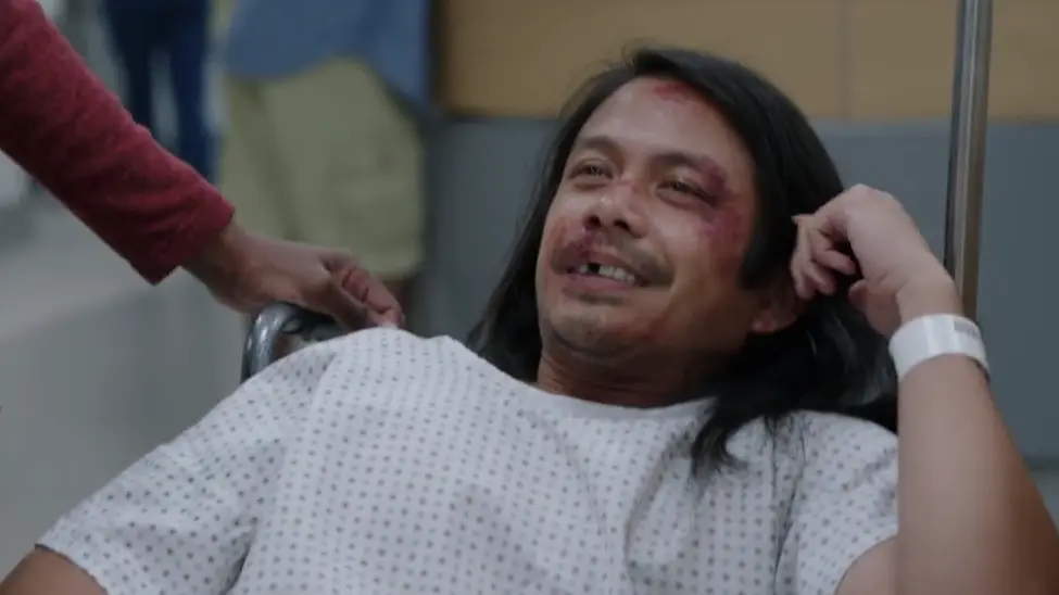 Facial trauma presenting with avulsion of maxillary central incisor (Tooth #8).