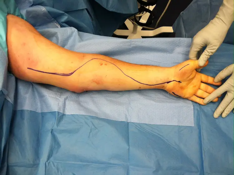 Surgical markings outlining the curvilinear incision path for a volar forearm fasciotomy.