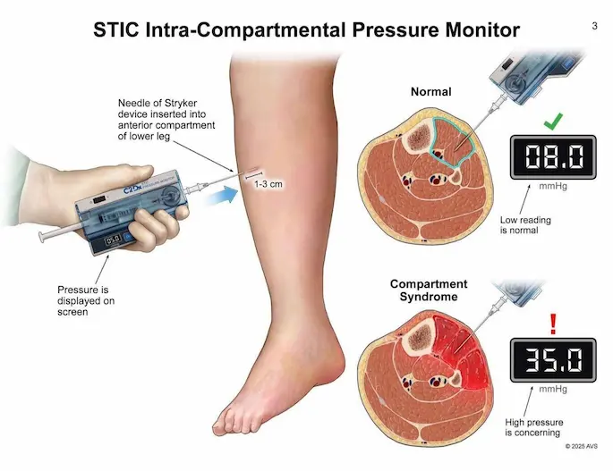 Diagram demonstrating the use and mechanics of a STIC Intra-Compartmental Pressure Monitor.