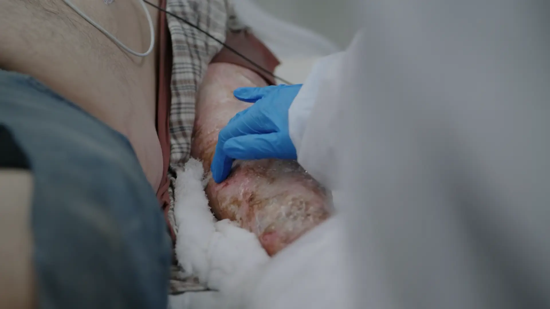 Dr. Santos' clinical assessment of the tense ventral compartment on the left forearm following the electrical burn.