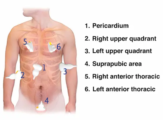 Diagrama anatômico das 6 janelas padronizadas do ultrassom utilizadas durante um exame E-FAST.