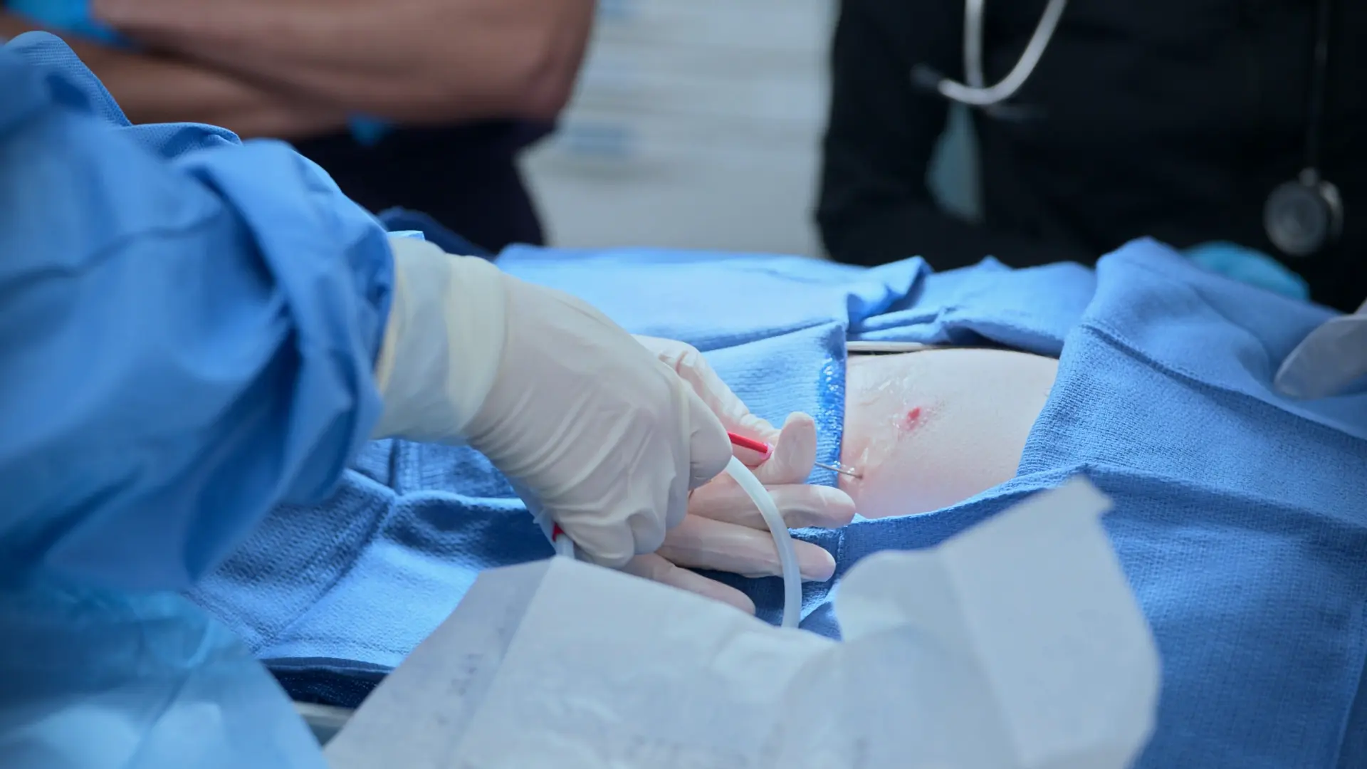 Colocação de um cateter pericárdico de demora com torneira de 3 vias após a aspiração inicial.