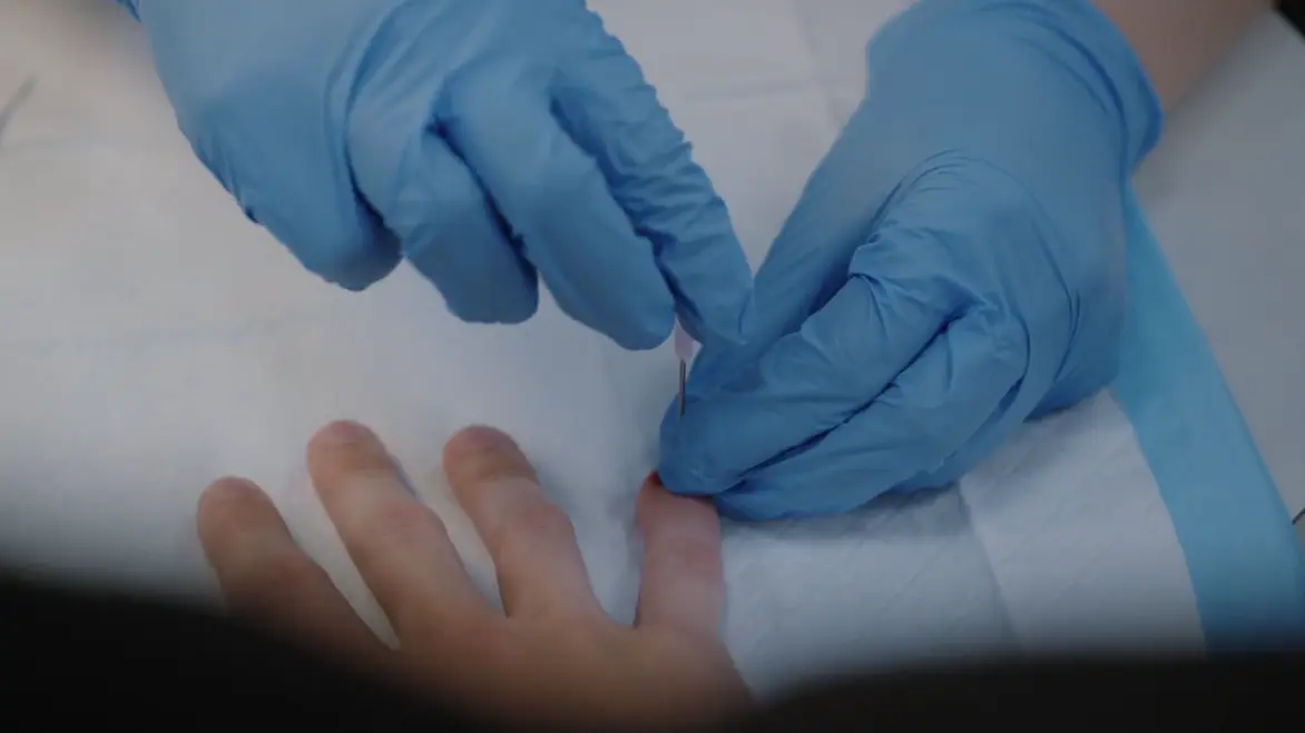 Utilisation d'une aiguille pour réaliser une trépanation sur un hématome sous-unguéal.