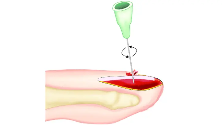 Schéma en coupe transversale de la trépanation unguéale utilisant la technique de rotation de l'aiguille.