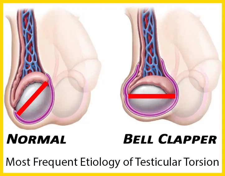 Diagramm, das die normale Hodenanatomie mit der Glockenklöppel-Deformität (Bell-Clapper-Anomalie) vergleicht.