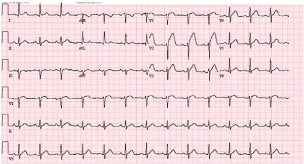 主にV2-V4誘導において、重度かつ上に凸の「墓石型」ST部分上昇を示す12誘導EKG。