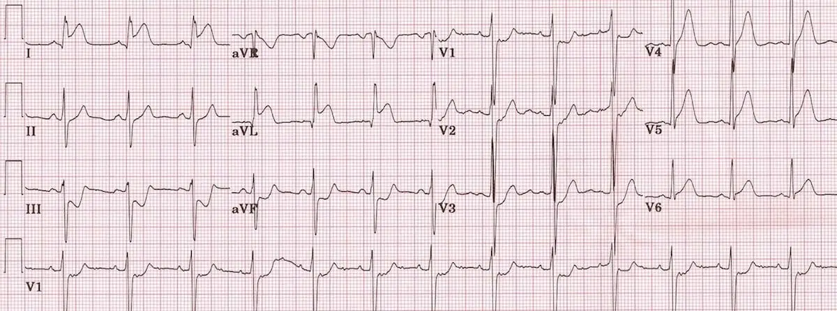 ECG 12 dérivations démontrant un STEMI latéral aigu.