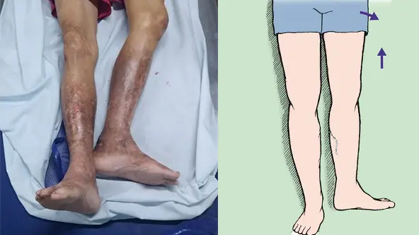 Extremidad característicamente acortada y en rotación externa, propia de una fractura desplazada de cadera.