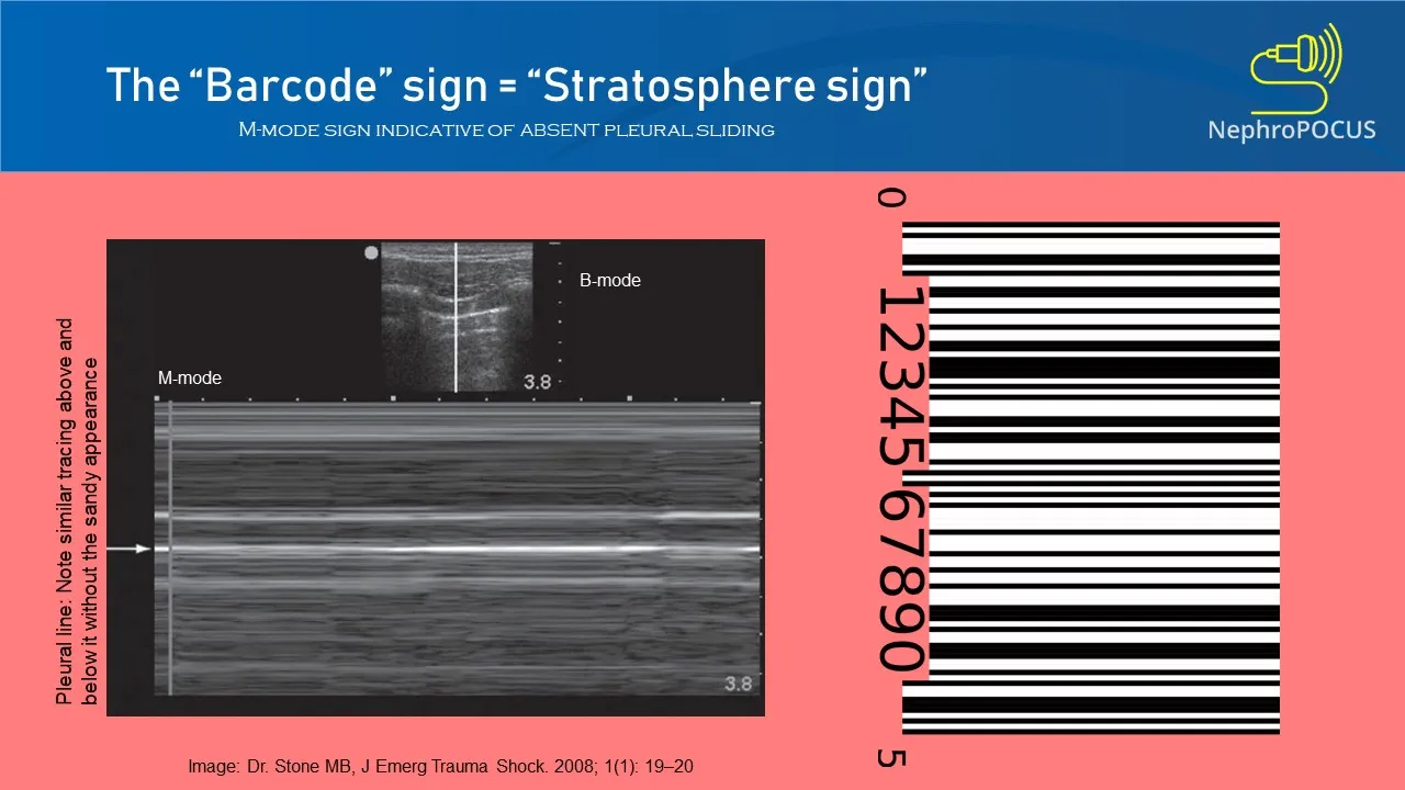 Ultrassom em Modo-M demonstrando o 'Sinal do Código de Barras' (ou Sinal da Estratosfera).