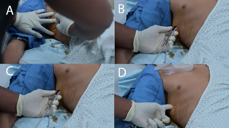Sequência rápida em quatro etapas para uma toracostomíia digital de emergência visando descomprimir um pneumotórax hipertensivo à direita.