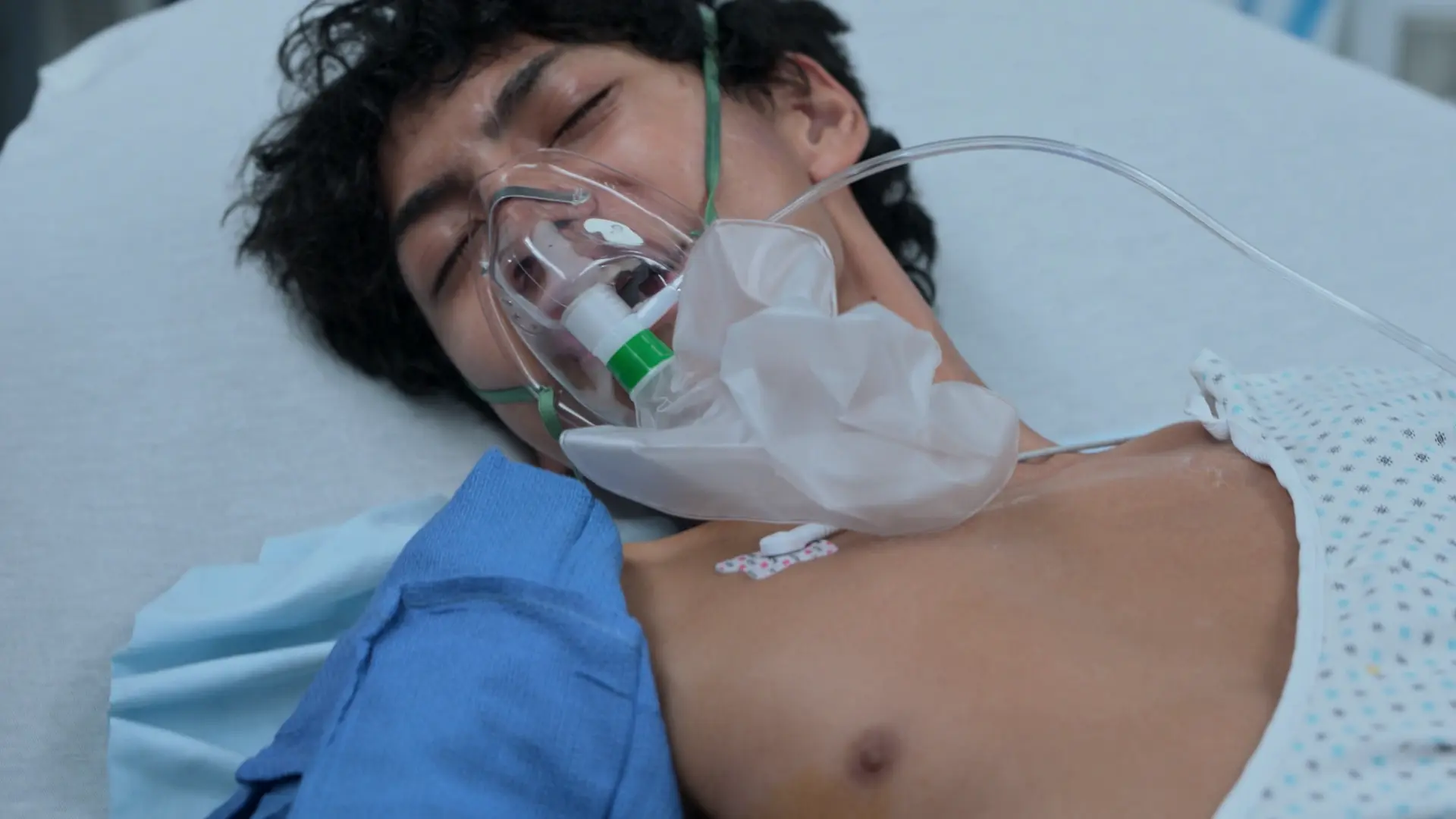 Paciente exibindo alívio respiratório imediato e inalação espontânea após a descompressão bem-sucedida de um pneumotórax hipertensivo à direita.
