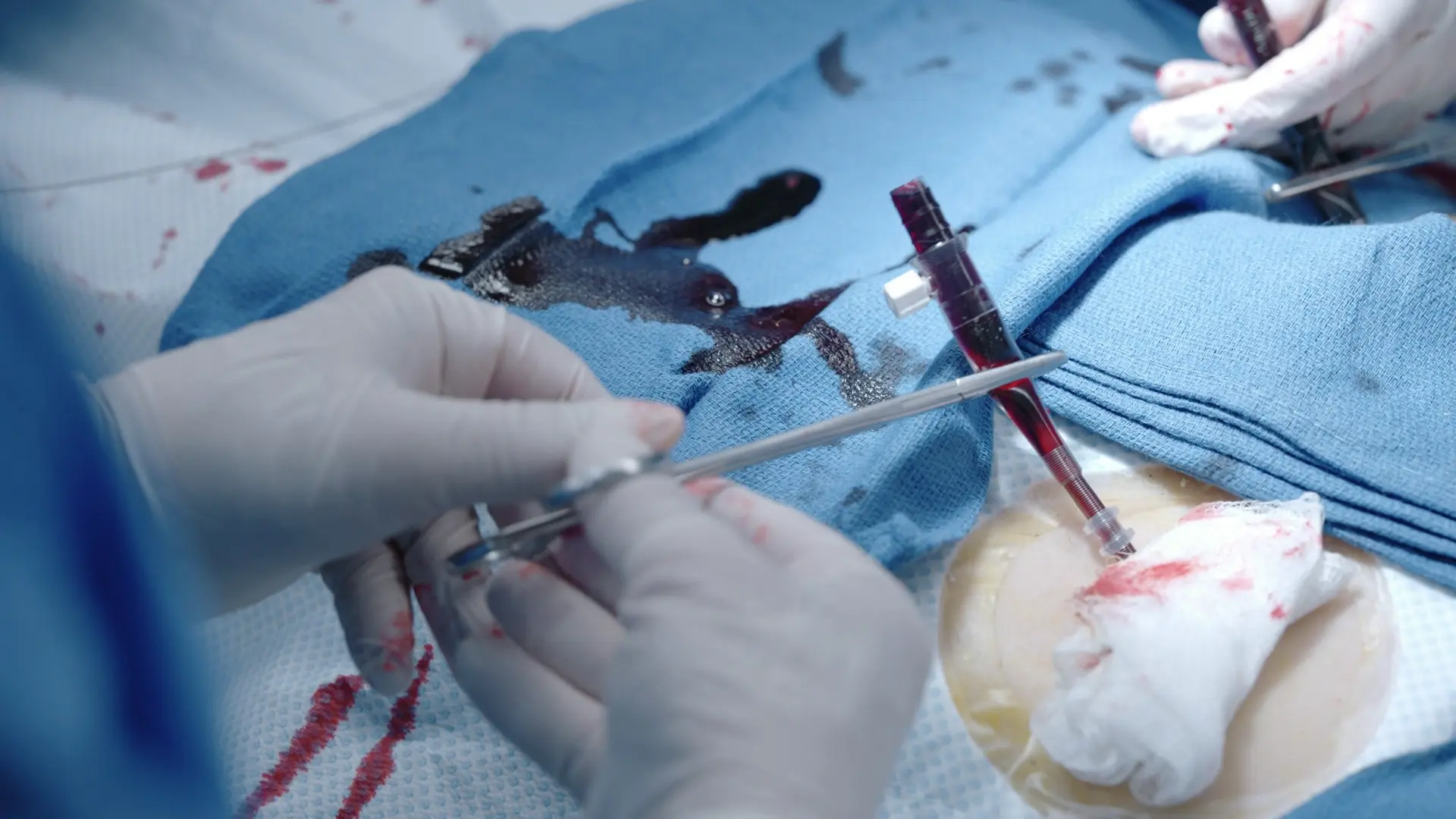 Première canule d'ECMO VA insérée avec succès et clampée.