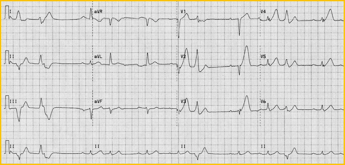 ECG 12 dérivations révélant un STEMI antérieur aigu.