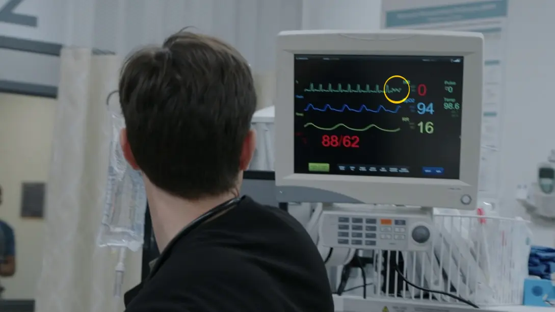Moniteur cardiaque saisissant l'instant exact où le rythme du patient dégénère en fibrillation ventriculaire.