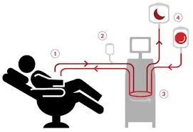 Diagram of an automated red blood cell exchange (erythrocytapheresis).