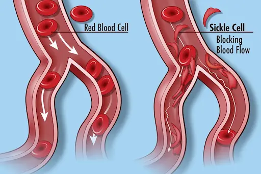 Diagramm zur Veranschaulichung einer vaso-okklusiven Krise, bei der sichelförmige Erythrozyten den Blutfluss in einem bifurkierenden Blutgefäß physisch blockieren.
