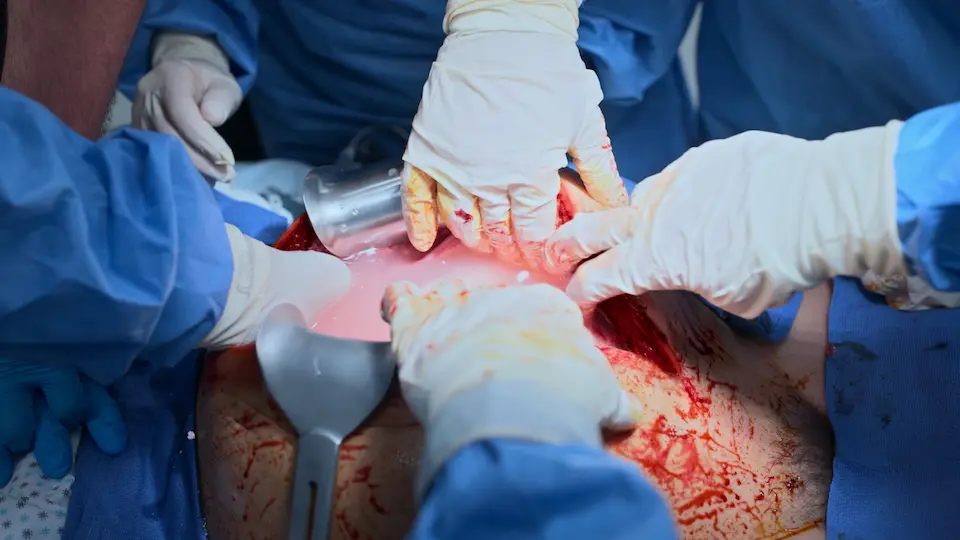 子宮下部を切開した際の羊水の外科的視野。