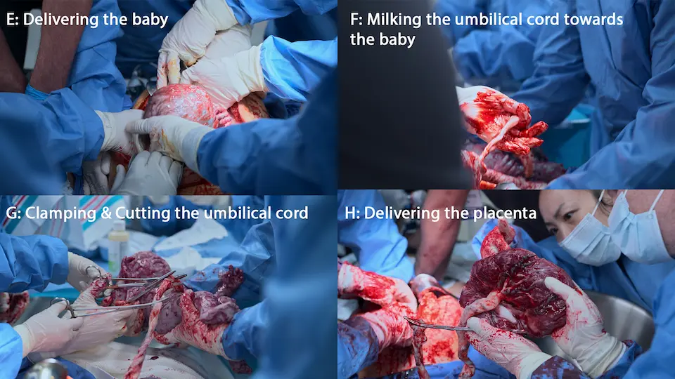 蘇生的子宮切開のその後の手順：乳児および胎盤の娩出。