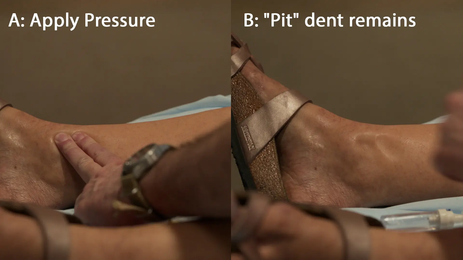 患者の下肢における重度の圧痕浮腫（pitting edema）の所見。