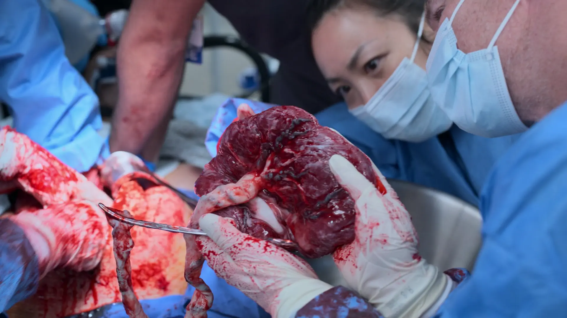 新たに娩出された胎盤の母体面を点検し、完全に欠損がないことを確認するGarvin看護師。