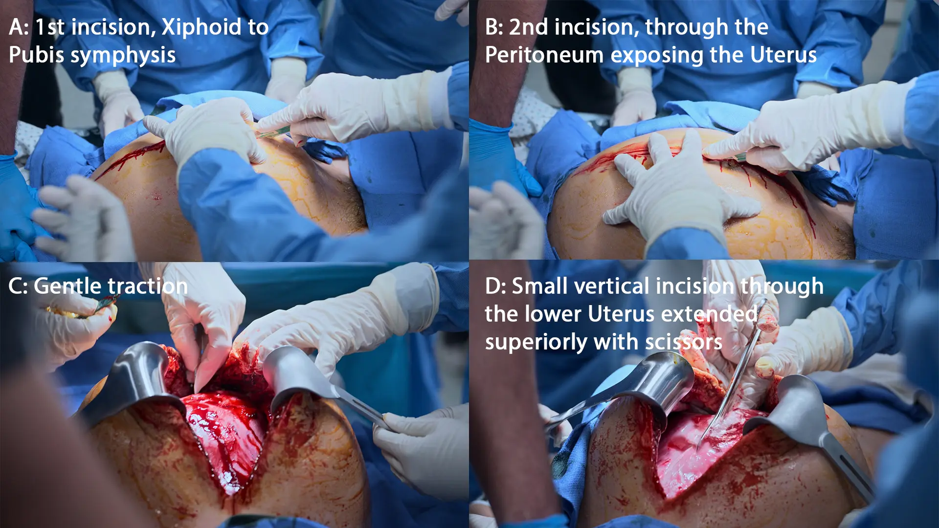 救急部門における蘇生的子宮切開の段階的な外科的アプローチ。