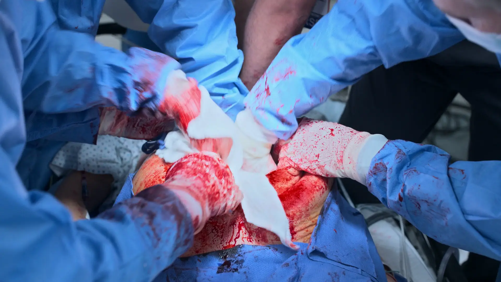 大量出血を制御するため、開いた子宮に開腹術用スポンジ（lap pads）を積極的にパッキングするRobbyと外科チーム。