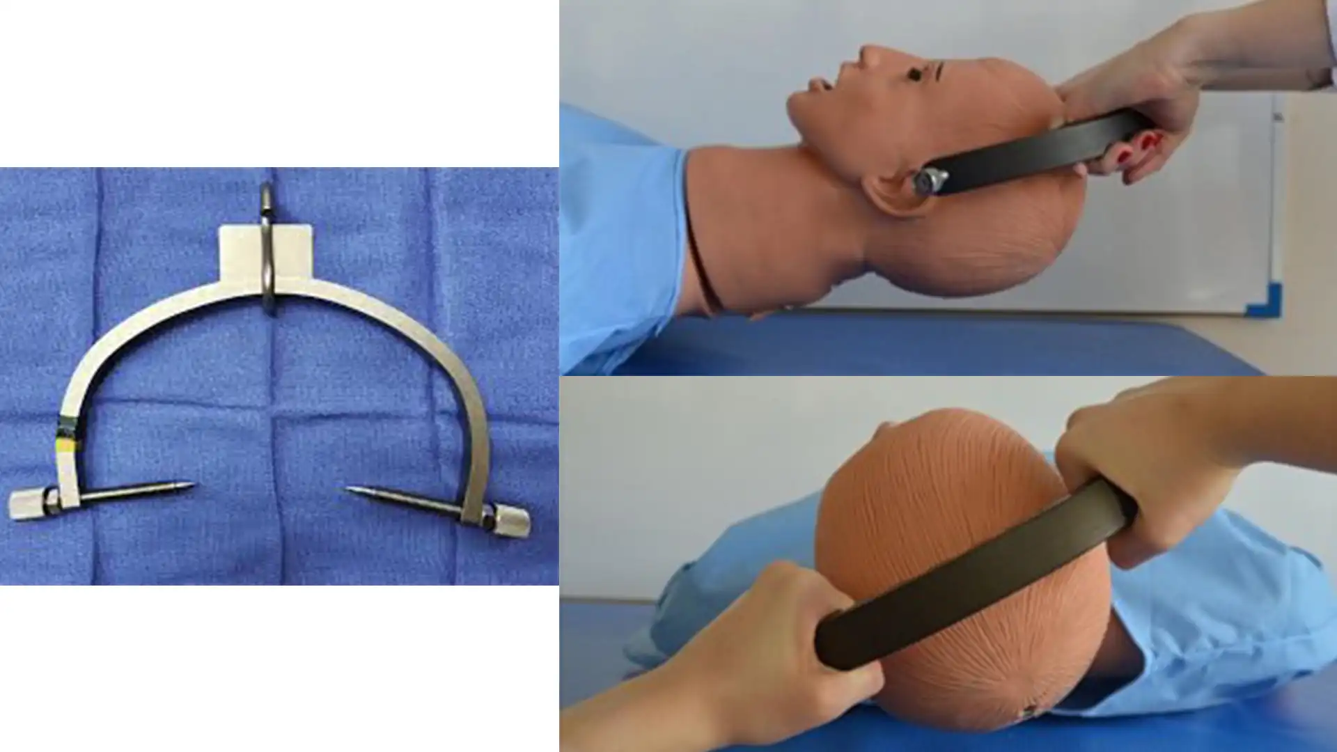 頸椎の骨牽引に使用される標準的な医療器具であるガードナー・ウェルズ鉗子。