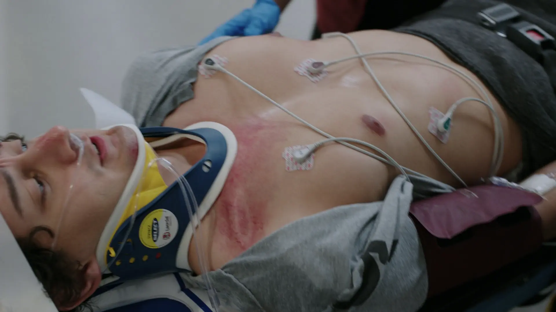 Paciente que llega a la sala de reanimación con collarín cervical y electrodos de ECG colocados. Se aprecia una depresión y eritema evidentes sobre la articulación esternoclavicular derecha.