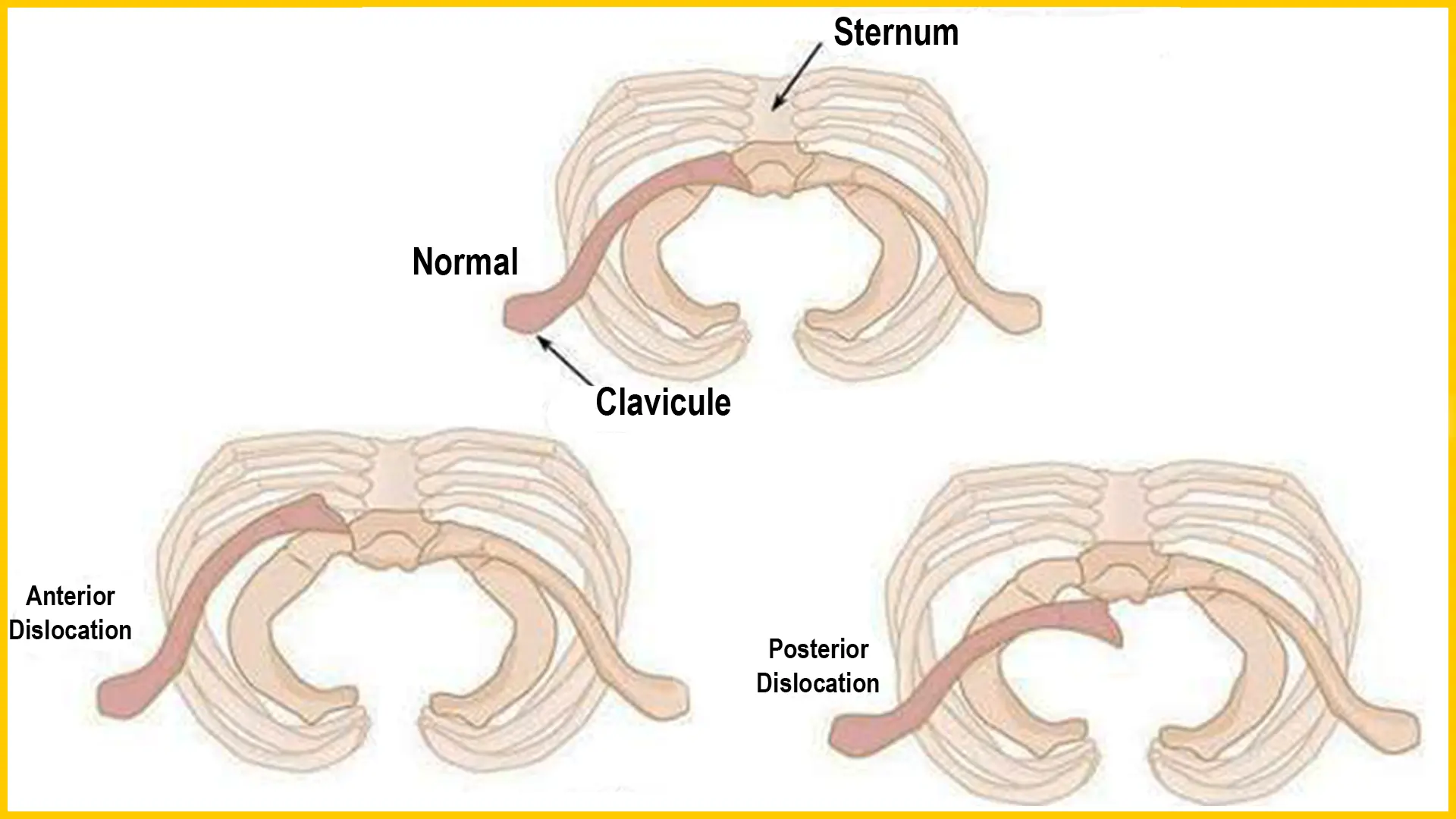 Ilustración anatómica que compara una articulación esternoclavicular normal con luxaciones anteriores y posteriores.
