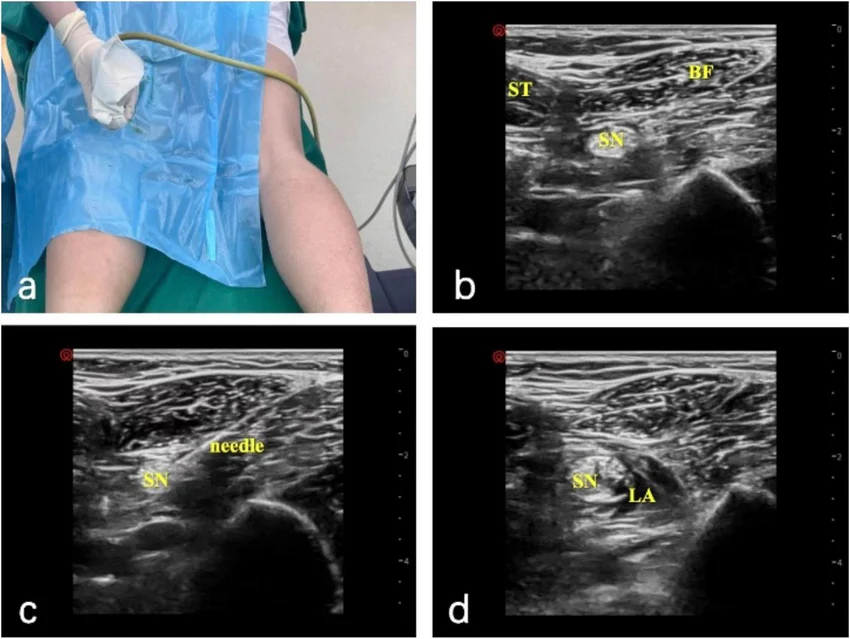 Ultrasound Guided Popliteal Block