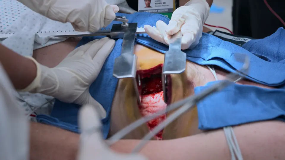 Toracotomia de reanimação no Departamento de Emergência com aplicação de uma pinça de Satinsky na aorta descendente.