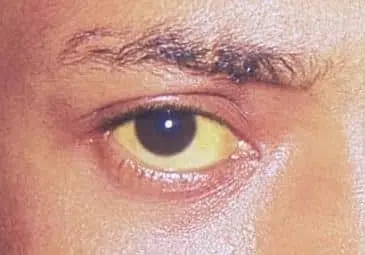 Apresentação clínica de icterícia escleral em paciente com hepatite aguda grave.