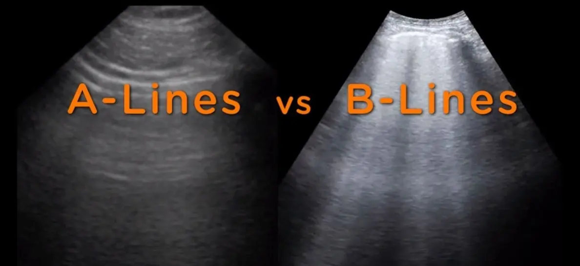 Comparaison entre les lignes A normales et les lignes B pathologiques à l'échographie pulmonaire.