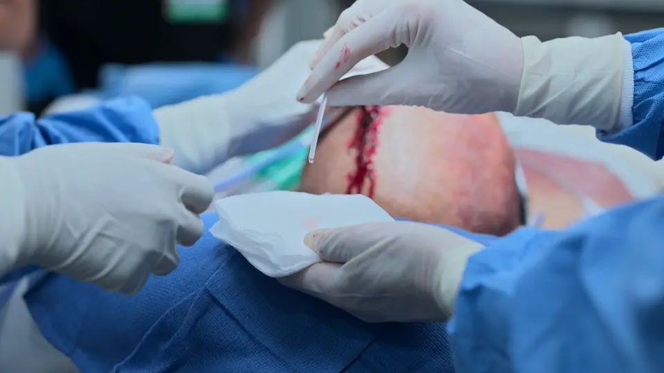 Confirmation of successful EVD placement with clear Cerebrospinal Fluid (CSF) drainage.