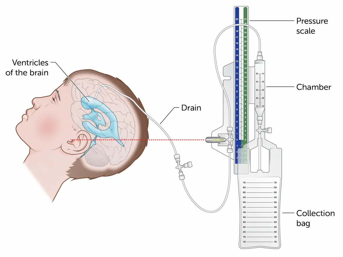 Bedside External Ventricular Drain (EVD) placement.
