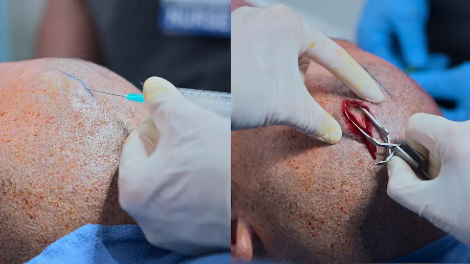 Local anesthesia administration and initial scalp incision with retraction.