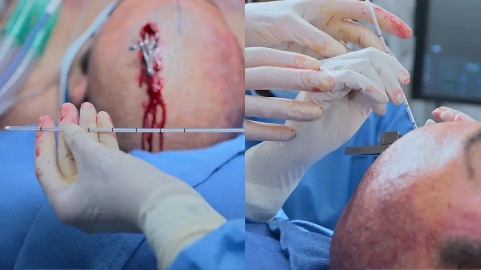 Insertion of the EVD catheter, utilizing depth markers and a stylet, aiming toward the medial canthus.