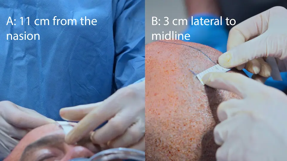 Measuring Kocher's Point: 11 cm posterior from the nasion and 3 cm lateral to the midline.