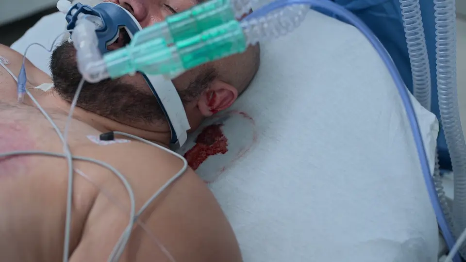 Sero-sanguinous fluid from the ear demonstrating the Halo Sign.