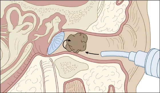 Diagrama anatómico que ilustra la técnica adecuada de irrigación ótica empleada para expulsar suavemente la cucaracha muerta.