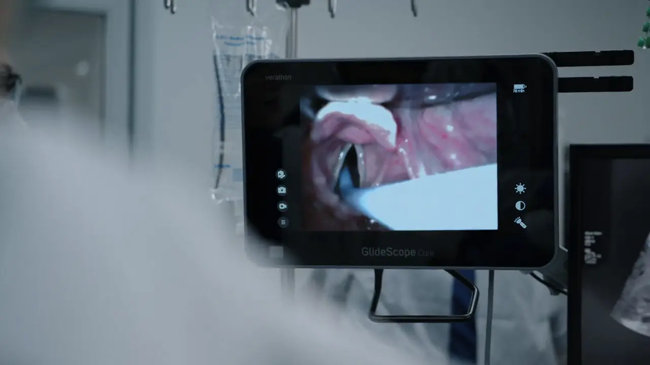 Intubation utilisant une bougie avec une courbure distale (bougie béquillée / mandrin d'Eschmann).