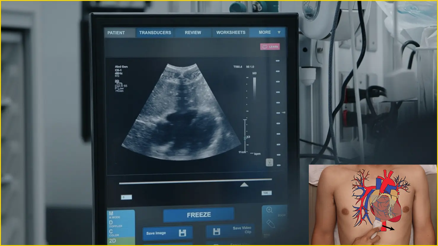 E-FAST検査中の剣状突起下心窩部アプローチを描出するPoint-of-care超音波(POCUS)。