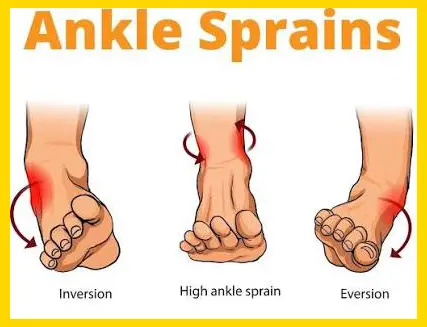 Diagram illustrating the three primary mechanisms of ankle sprains: Inversion, High ankle sprain (syndesmotic), and Eversion.