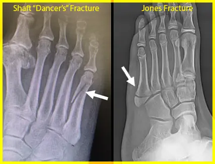 Radiographic comparison of a shaft 'Dancer's' fracture and a Jones fracture.